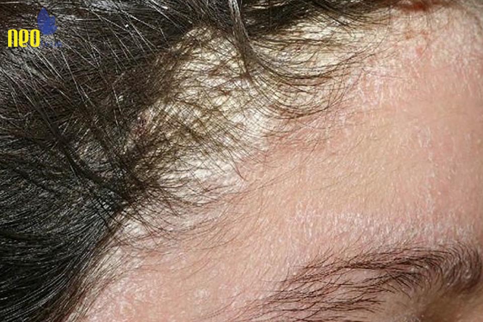 nguyen nhan gay gau 2